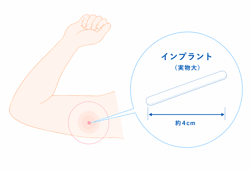 避妊インプラントとは？