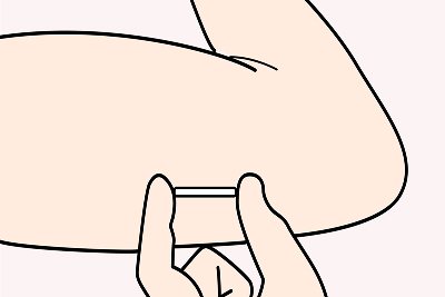 避妊インプラント（ネクスプラノン）とは？